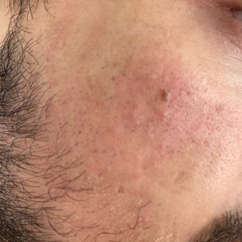 Gliss Şampuan Cildimi Yaktı