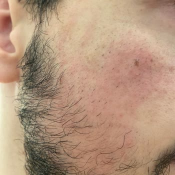 Gliss Şampuan Cildimi Yüzümü Yaktı