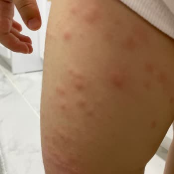 Eyüp Sabri Tuncer Doğal Zeytinyağlı Bebek Şampuanı Alerji Yaptı