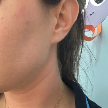 La Roche Güneş Kremi Kızarıklık Yapıyor