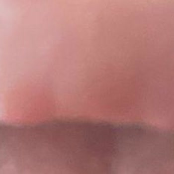 Mecidiyeköy Clinica Dudak Dolgusu Şikayetim