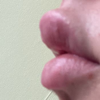 Mecidiyeköy Clinica Dudak Dolgusu Şikayetim