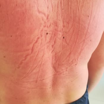 Tokalon Spf50 Güneş Koruyucusu 1. Derecede Güneş Yanığına Sebep Oldu