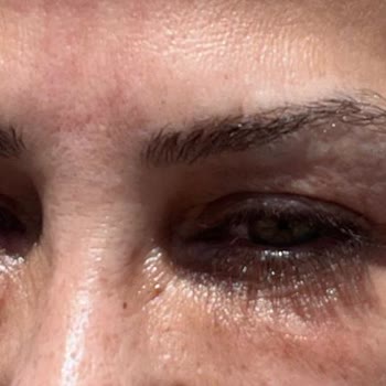 Makk Güzellik Salonu Hatalı Estetik İşlemi