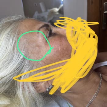 Makk Güzellik Salonu Hatalı Estetik İşlemi