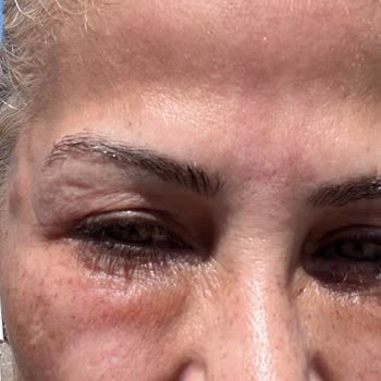 Makk Güzellik Salonu Hatalı Estetik İşlemi