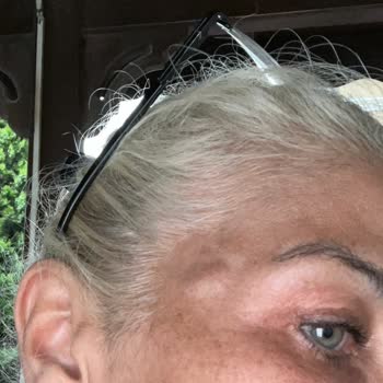 Makk Güzellik Salonu Hatalı Estetik İşlemi