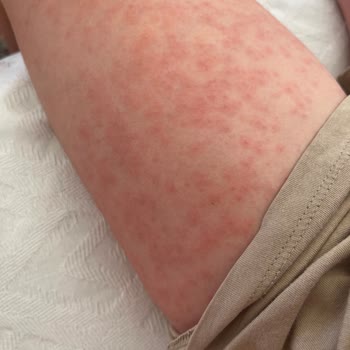 Nivea Kids Güneş Koruyucu Krem Alerjisi