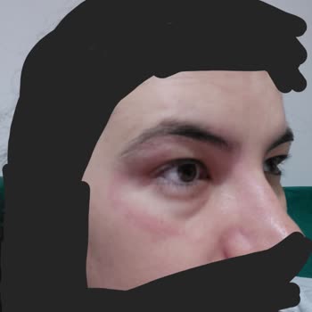 Bee Beauty Micellar Makyaj Temizleme Suyu Yüzümü Alerji Yaptı