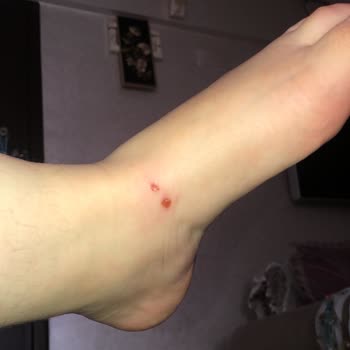 Sandaletin Ayağımı Yara Etmesi Stradivarius