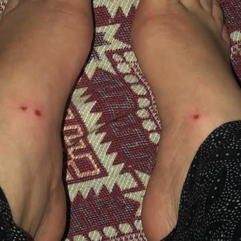 Sandaletin Ayağımı Yara Etmesi Stradivarius