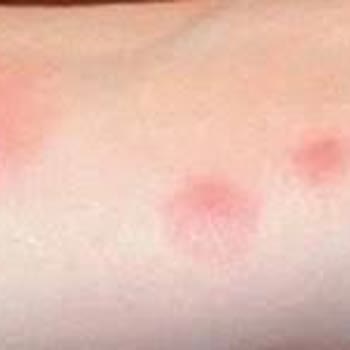 Zehra Hotels & Villas Klima ve Sivrisinek