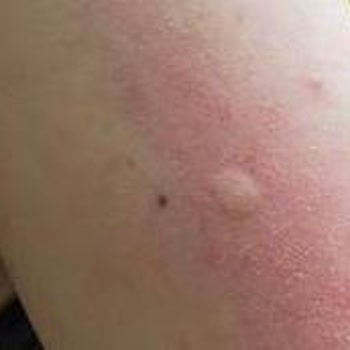 Zehra Hotels & Villas Klima ve Sivrisinek