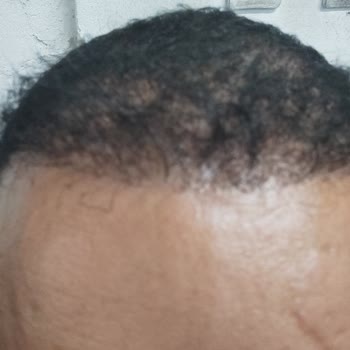 Clinic Expert Ekilen Saçların Tutmaması Dökülmesi!