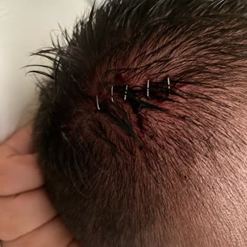 Loxia Comfort Club Side Loxia Comfort Clup Side İsimli Otel Yaralı Halde Otelden Çıkardılar