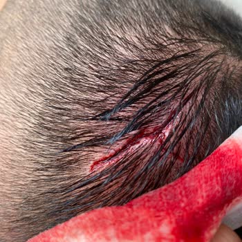 Loxia Comfort Club Side Loxia Comfort Clup Side İsimli Otel Yaralı Halde Otelden Çıkardılar