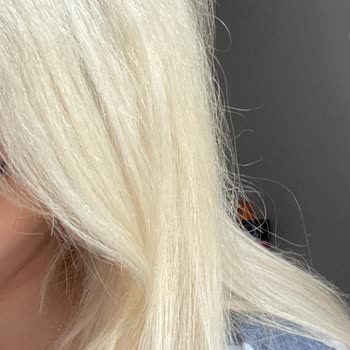 Emre Ayaksız Hair Palace Saçım Geri Dönüşü Olmaz Bir Şekilde Mahvoldu