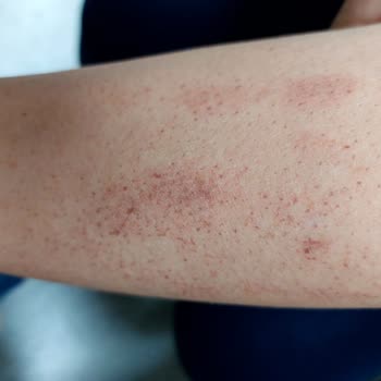 Ayşe Aksoy Güzellik Merkezi Lazer, Buz Lazeri