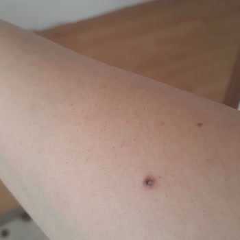 Ayşe Aksoy Güzellik Merkezi Lazer, Buz Lazeri