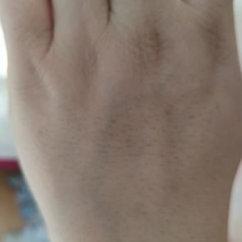 Ayşe Aksoy Güzellik Merkezi Lazer, Buz Lazeri