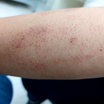 Ayşe Aksoy Güzellik Merkezi Lazer, Buz Lazeri