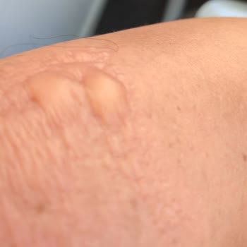 2. Derece Yanık Eda Taşpınar Bronzlaştırıcı Bomba