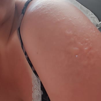 2. Derece Yanık Eda Taşpınar Bronzlaştırıcı Bomba