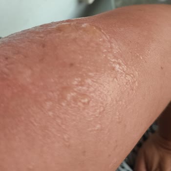 2. Derece Yanık Eda Taşpınar Bronzlaştırıcı Bomba