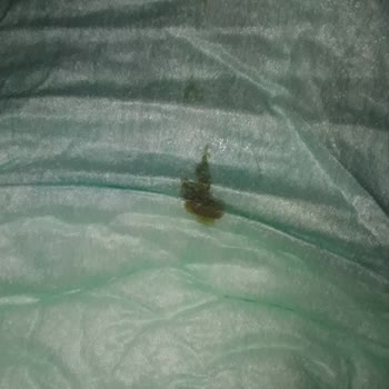 Molfix Bezlerde Hata Ve Leke