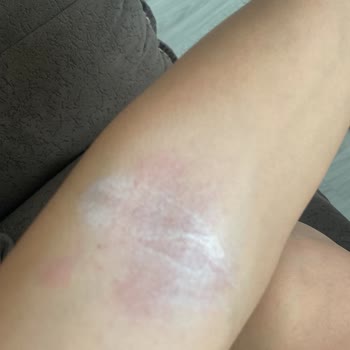 Eda Taşpınar Ciltte İsilik Oluşumu