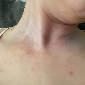 Eda Taşpınar Ciltte İsilik Oluşumu