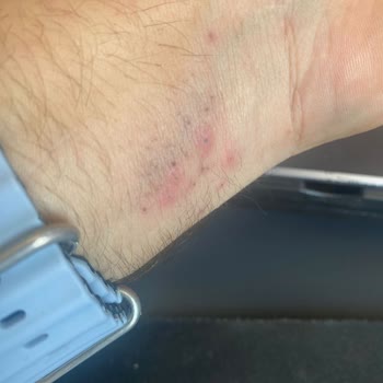 Apple Wacht Ultra Saat Kordonu Yara Yapıyor