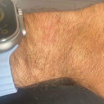 Apple Wacht Ultra Saat Kordonu Yara Yapıyor