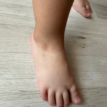 Skechers Çocuk Sandalet Kızımın Bilek Kısmını Mahvetti