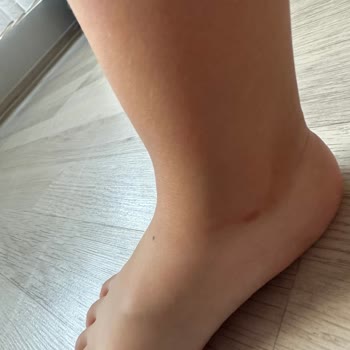 Skechers Çocuk Sandalet Kızımın Bilek Kısmını Mahvetti