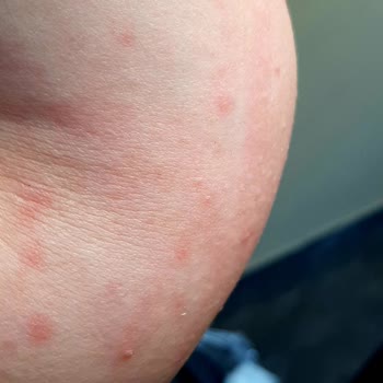 Forx5 Kahve Alerjik Reaksiyon