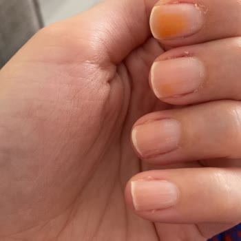 Pastel Kozmetik Pastel Ojede Tırnakta Turuncu Leke Oluşması