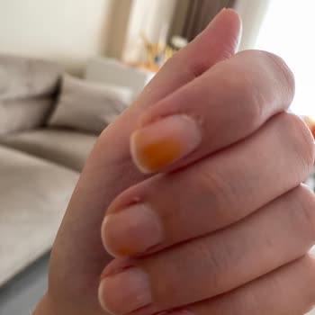 Pastel Kozmetik Pastel Ojede Tırnakta Turuncu Leke Oluşması