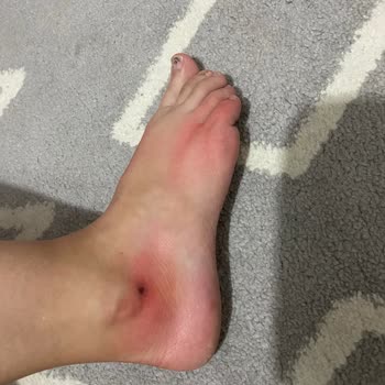 Sneaks Up Kızımın Ayaklarını İlk Kullanımda Alerji Yapan Ayakkabıyı İade Almıyor