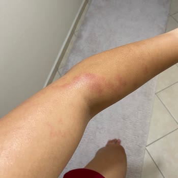 Novar Poliklinik Cildimde Fazlasıyla Yanık Var