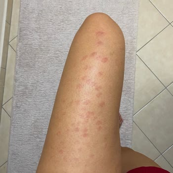 Novar Poliklinik Cildimde Fazlasıyla Yanık Var