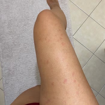 Novar Poliklinik Cildimde Fazlasıyla Yanık Var