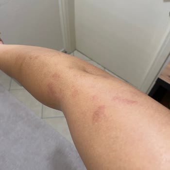 Novar Poliklinik Cildimde Fazlasıyla Yanık Var