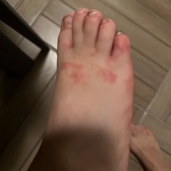 Adidas Sandalet Yara Yapıyor