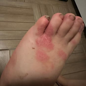 Adidas Sandalet Yara Yapıyor