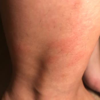 Converse Ayakkabı Alerji Yapıyor