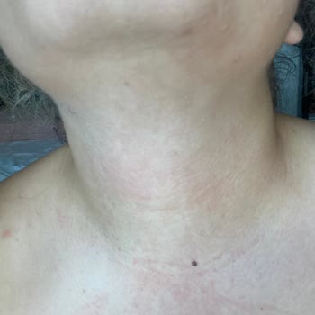 Bargello Perfume Bargello Parfümler Kaşıntı Kızarıklık