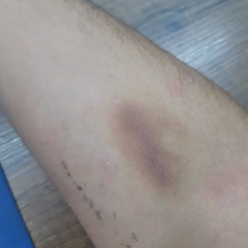 Özel Hatem Hastanesi Gaziantep Yanlış Müdahale