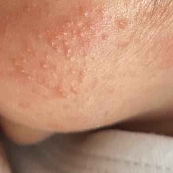 Mustela Şampuan Alerjik Reaksiyon