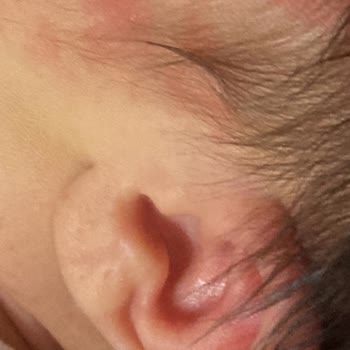 Mustela Şampuan Alerjik Reaksiyon